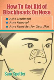 How To Get Rid of Blackheads On Nose (Acne Treatment, Acne Removal, Acne Remedies For Clear Skin)
